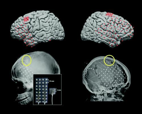 images of four brains with implants