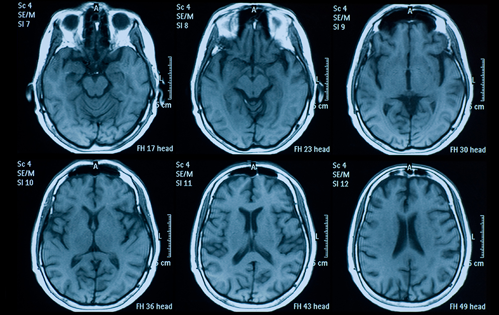 Brain MRI