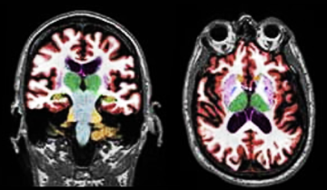 Alzheimers Disease Clinical Decision Support Tool