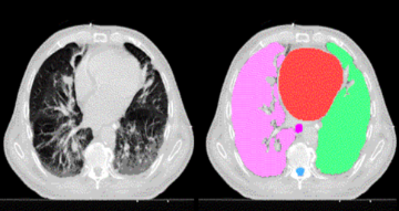 Applied Machine Learning in Medical Imaging